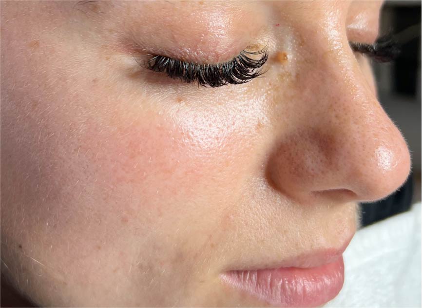 Acne treatment on clear woman's face