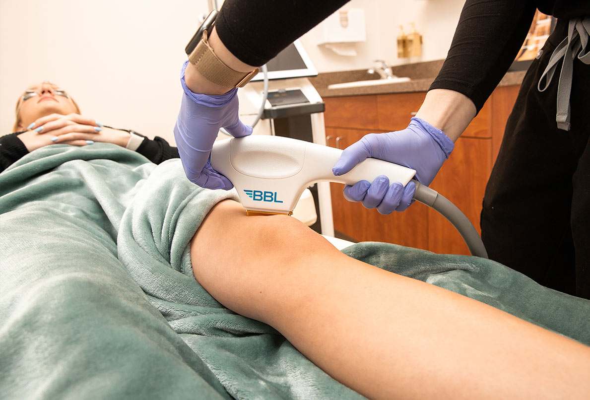 Laser hair removal treatment on woman's leg at Ascent Med Spa in Laramie