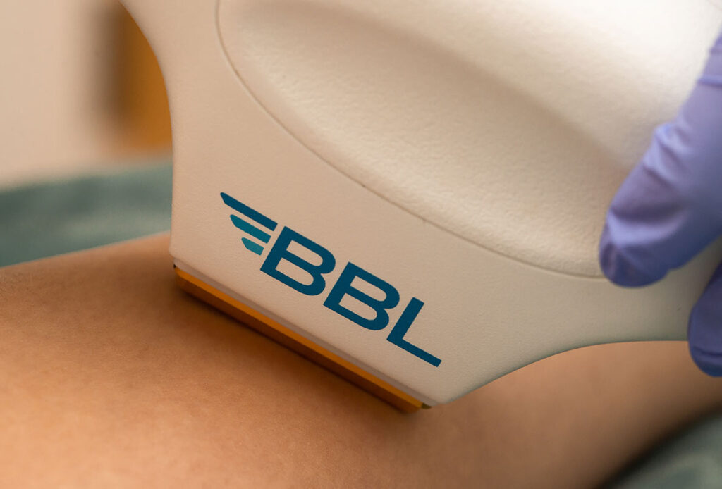 Laser hair removal up close of BBL