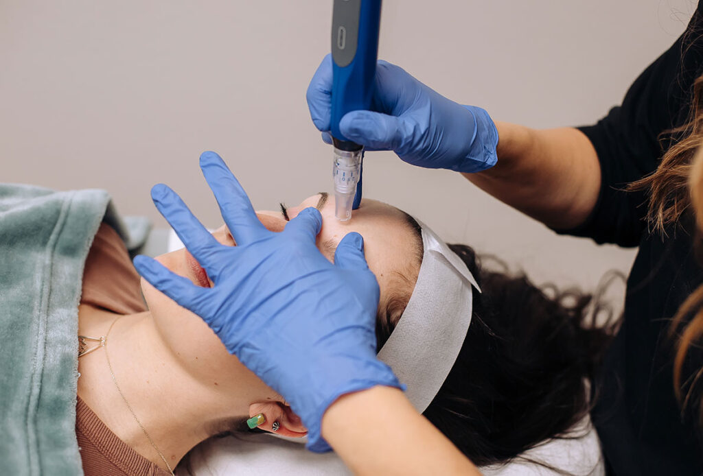 SkinPen microneedling on a woman at Ascent Med Spa in Laramie