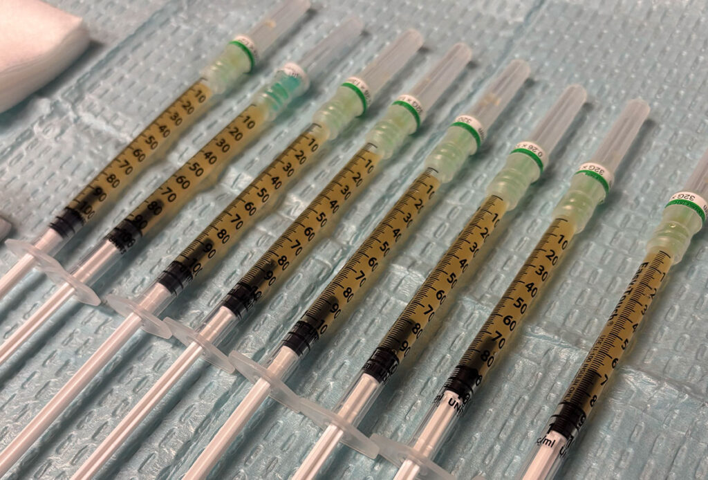 PRP needles