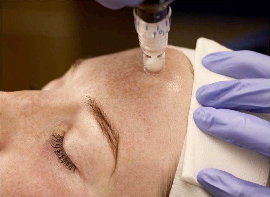 SkinPen Microneedling on woman in Laramie, WY