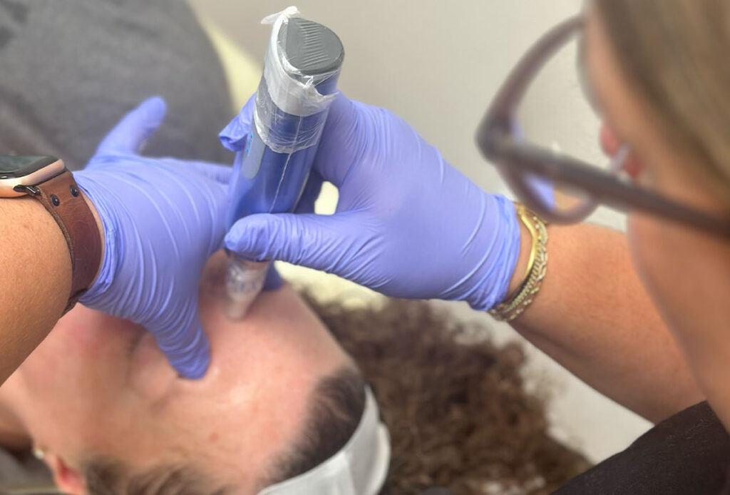 Up close of patient receiving SkinPen microneedling at Ascent Med Spa